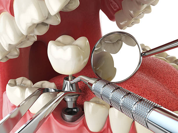 Best Emergency Root Canal Treatment in Prices Fork, VA